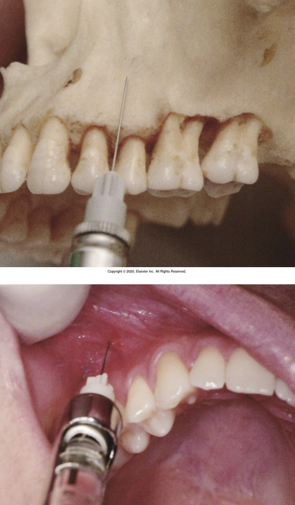 <ul><li><p>Height of mucobuccal fold above maxillary second premolar</p></li></ul><p></p>