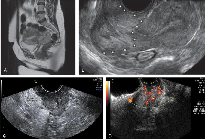 <p>• <strong><em>Squamous cell carcinoma is the most common type of cervical</em></strong></p><p class="p1"><strong><em>cancer.</em></strong></p><p class="p1">• Precursors are cervical dysplasias classified as mild, moderate, or</p><p class="p1">severe.</p><p class="p1">• When full thickness of epithelium composed of undifferentiated</p><p class="p1">neoplastic cells, lesion referred to as carcinoma in situ</p><p class="p1">• The detection of these abnormalities is attributed to screening with</p><p class="p1">Papanicolaou (Pap) smears because most of the early lesions are</p><p class="p1">asymptomatic.</p><p class="p1">• Advanced cervical cancer is usually evident clinically.</p><p class="p1">• Sonography may demonstrate a solid retrovesical mass, which may be</p><p class="p1">indistinguishable from a cervical myoma.</p><p class="p1">• Transvaginal and translabial ultrasound may demonstrate bladder,</p><p class="p1">ureteral, vaginal, or rectal involvement and may be used in staging</p><p class="p1">cervical cancer.</p><p class="p1">• CT and MRI are preferable because they are superior methods for</p><p class="p1">staging and evaluating lymphatic spread.</p><p class="p1">• Areas of increased echogenicity or hypoechoic areas with an irregular</p><p class="p1">outline signify changes compatible with cervical carcinoma.</p><p class="p1">• Ultrasound is also helpful in guiding biopsies of the cervix and vagina.</p><p class="p1">• Translabial or transperineal sonography may be used instead of or with</p><p class="p1">the transvaginal approach to help define the cervical area.</p>
