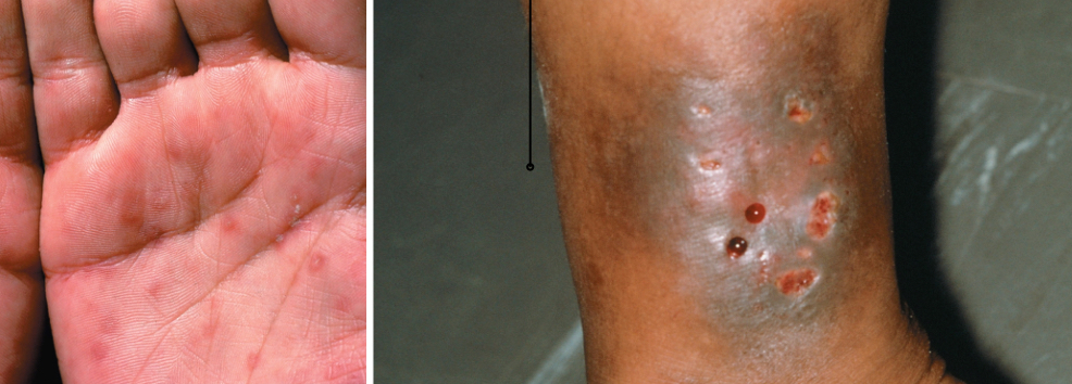 <p><span>Agent: </span><em><span>T. pallindum</span></em></p><p><u><span>Primary phase: </span></u><span>Small, painless, hard lesion known as a chancre (ulceration)</span></p><p class="s44"><span>•Often unobserved</span></p><p class="s44"><u><span>Secondary phase:</span></u></p><p class="s91"><span>Widespread rash, sore throat, headache, mild fever, malaise, myalgia</span></p><p class="s91"><u>Latent phase :</u> usually ends here;antimicrobial drugs </p><p class="s91"><span style="background-color: transparent;"><u><span>.Tertiary phase</span></u><span>: years later, untreated patients experience</span><strong><span> dementia, blindness, paralysis, heart failure, or</span><u><span> syphilitic gummas</span></u><span>( tumor like growth)</span></strong></span></p>