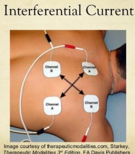 <p>Uses 4 electrodes to produce two slightly different AC frequencies that meet in the middle and target that middle spot (like an X)</p><p>More comfortable and targets deeper tissue</p>