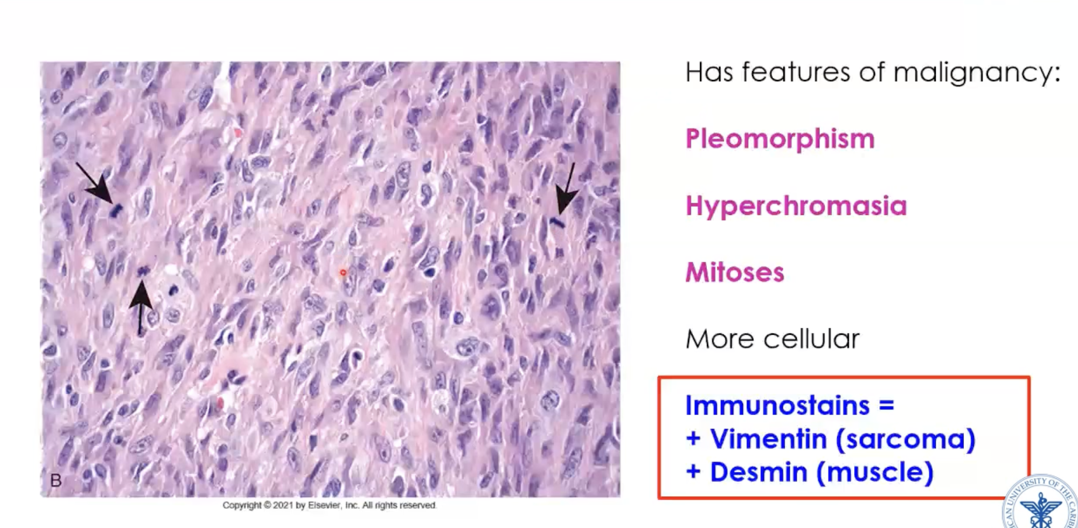 <p>Smooth muscle tumor</p>
