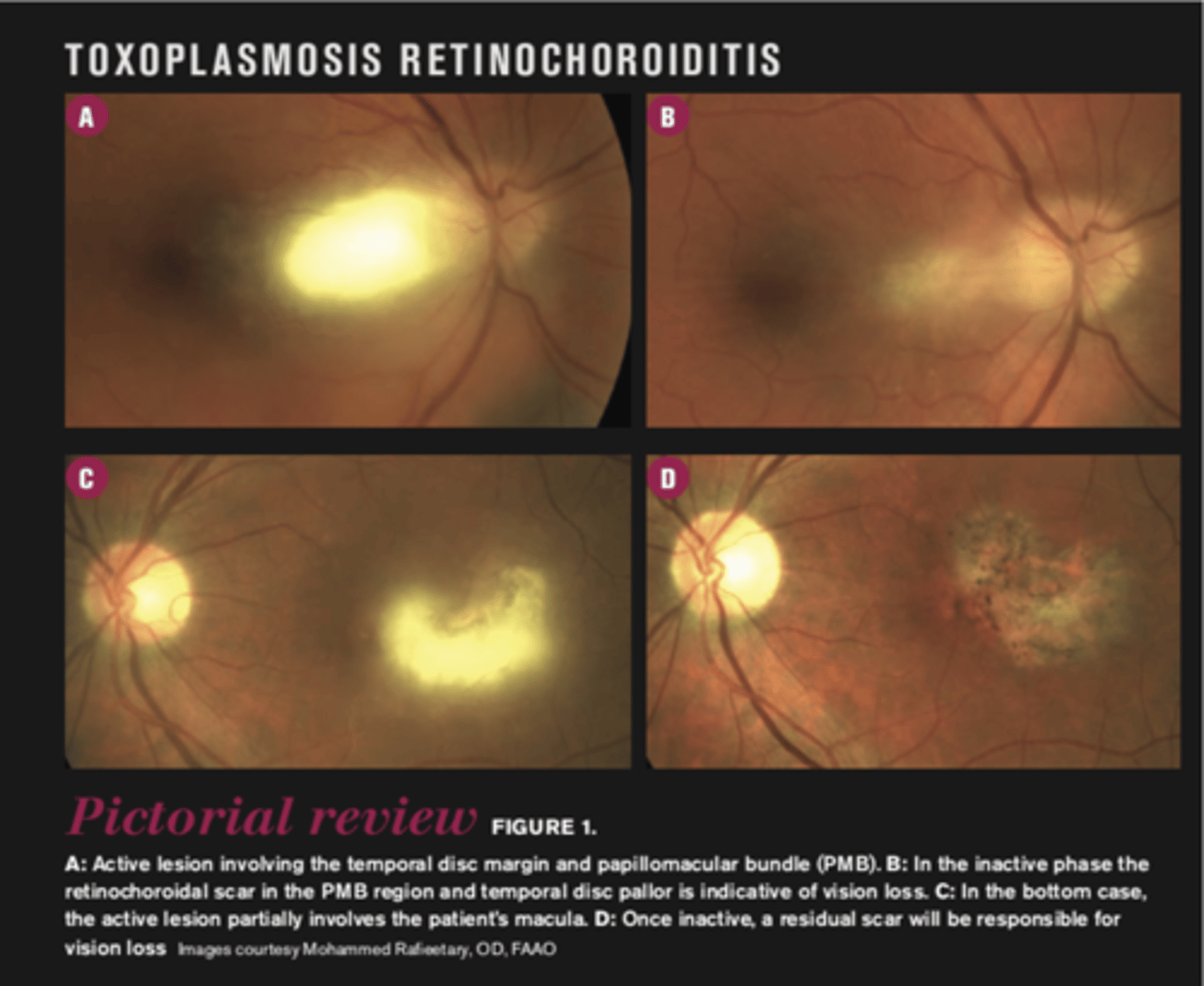 <p>scarring overtime with VA loss/scotoma</p>