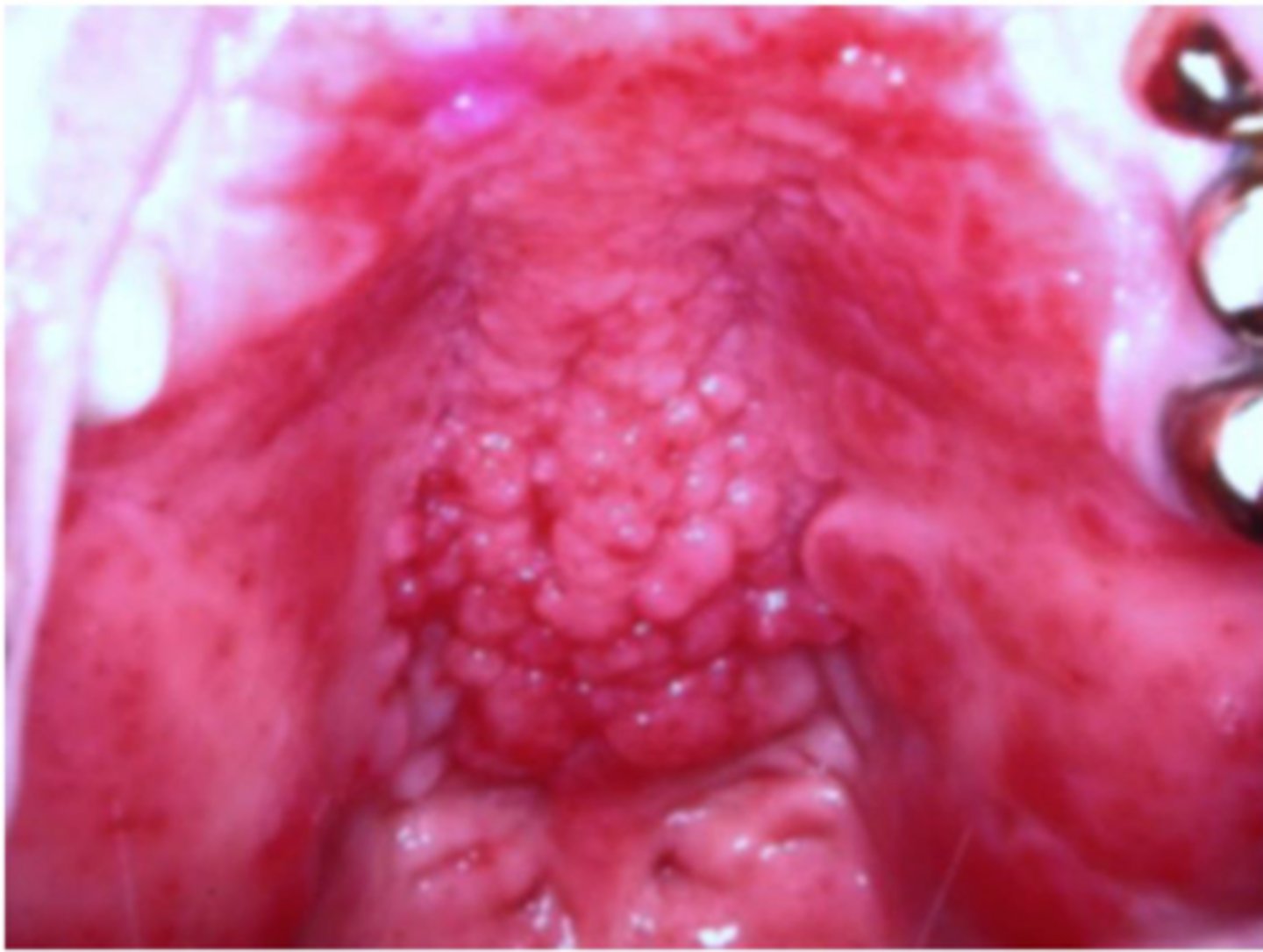 <p>AKA denture papillomatosis</p><p>• red (or pink) cobblestone appearance of hard palate</p><p>• under a prosthesis </p>