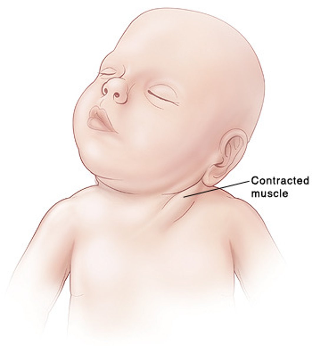 <p>"wryneck"; head turns to one side or is pulled backwards or forwards</p>