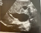 <p>A 6 month old boy of Asian ethnicity is seen by the pediatrician for abd. pain and vomiting. The physician notes physical signs of jaundice, and on questioning, the parent reports this has been present since birth. The physician is also able to palpate a RUQ mass. A sonogram is performed, and a balloon-like dilation of the CBD and mild intrahepatic ductal dilation are seen. Discuss the likely cause of this mass and the significance of the clinical findings. </p>