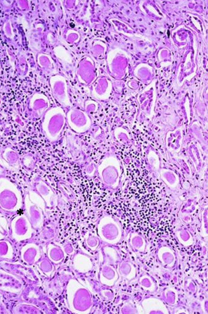 <p>What pathology is shown here? What is indicated at the asterisk?</p>