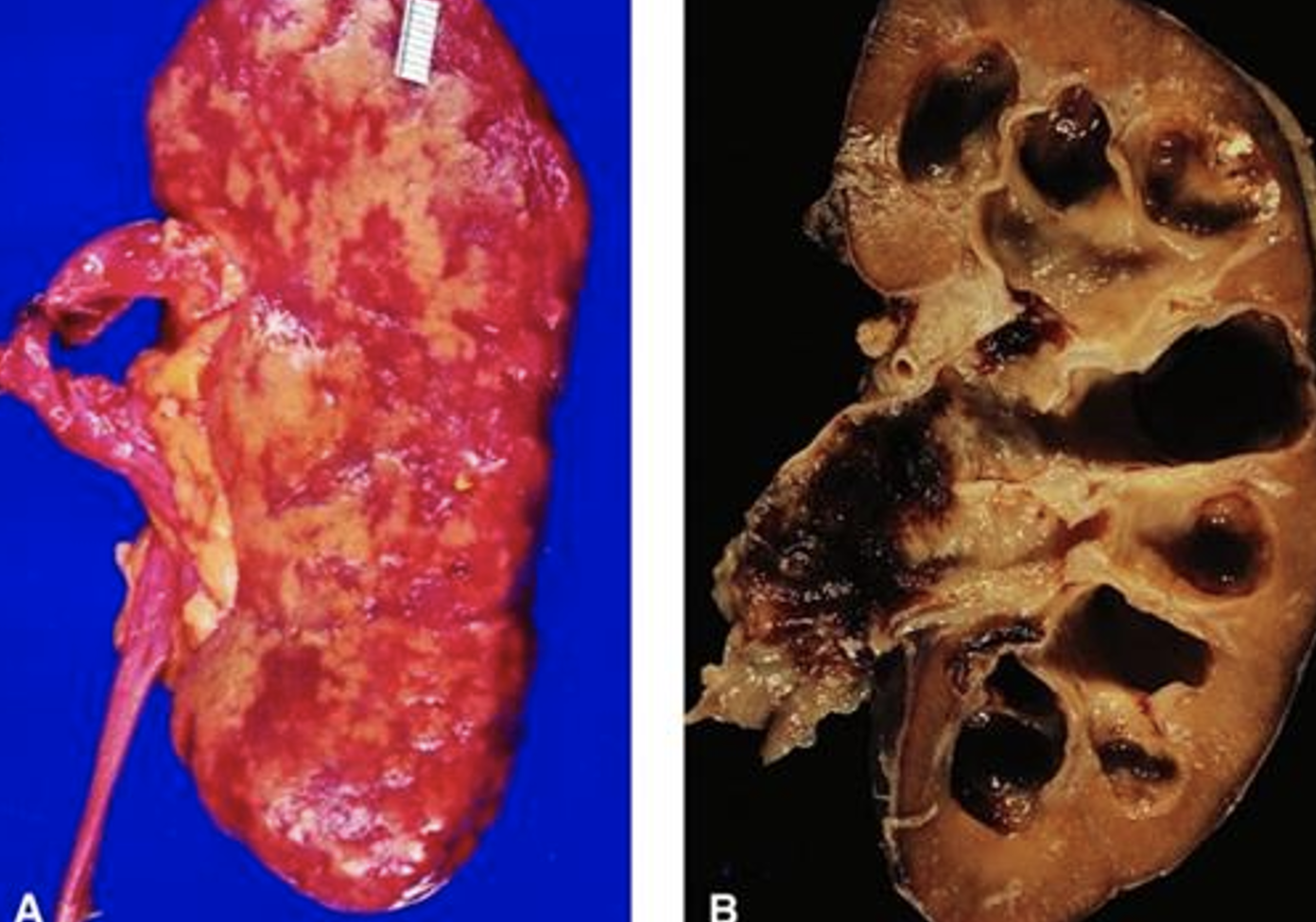 <p>What pathology is shown here?</p>