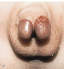 <p>What specific male “embryonic structure” is affected and probably has incurred insult during its entire course of development which has led to this congenital defect affecting the external genitalia (check the picture: COMPLETE DIPHALLIA or Male with Two Glans and Two Dorsal Penile Shafts):</p><p>A. Müllerian Duct</p><p>B. Wolffian Duct</p><p>C. Unaleria</p><p>D. Genital Tubercle</p><p>E. Genital Swelling</p>