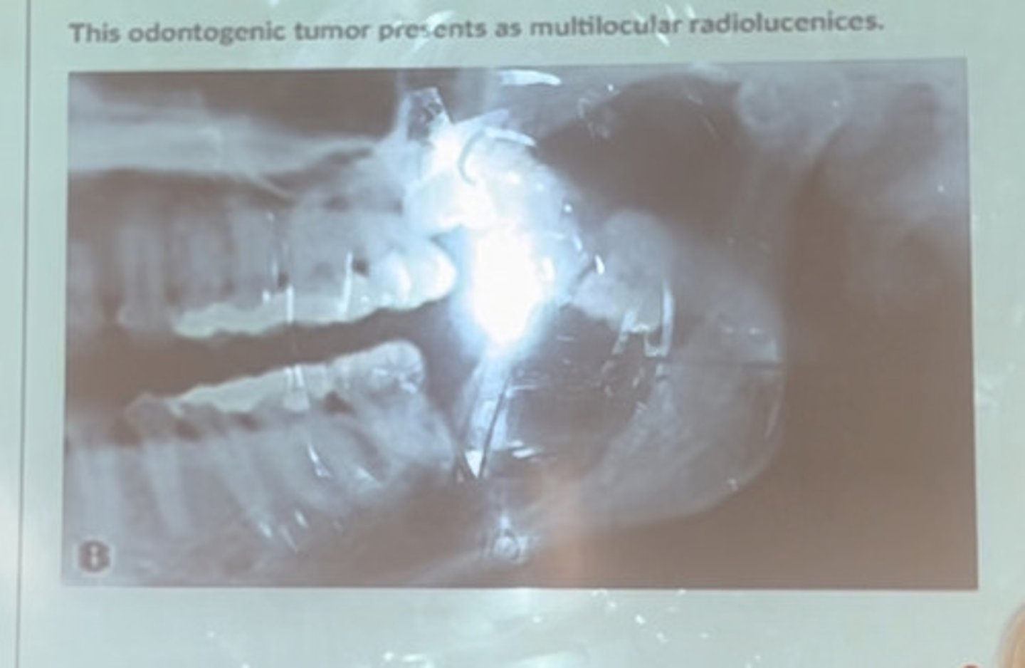 <p>This odontogenic tumor presents as multioculated radiolucencies</p>