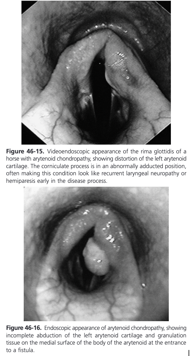 <ul><li><p><span>Usually made during endoscopic examination of the larynx</span></p><ul><li><p><span>RLN might be suspected because the arytenoid cartilage is in an adducted position and shows little movement</span></p></li><li><p><span>Affected cartilage is usually misshapen or distorted</span></p></li></ul></li><li><p><span>One of the endoscopic hallmarks of arytenoid chondropathy is the presence of intraluminal projections of granulation tissue</span></p><ul><li><p><span>Fistula or sinus tract in the center of the granulation tissue communicating with the body of the arytenoid is frequently present</span></p></li><li><p><span>A contact ulcer or projection of granulation tissue can often be seen on the opposing cartilage (kissing lesion) and the palatopharyngeal arch on the affected side is often more prominent</span></p></li></ul></li><li><p><span>In acute chondropathy, the predominant endoscopic feature is mucosal and submucosal perchondral edema and perilaryngeal swelling with intense hyperemia</span></p></li><li><p><span>Thickening around the muscular process can be palpated in cases of arytenoid chondropathy and might be the only diagnostic finding on palpation</span></p><ul><li><p><span>Larynx may feel less resilient to digital palpation and firm manual pressure may cause stridor or dyspnea</span></p></li></ul></li><li><p><span>Radiographic features of arytenoid chondropathy include abnormal patterns of cartilage mineralization, increased density of the arytenoid cartilages, abnormal contour or size of the corniculate process, obliteration of the laryngeal ventricle, and laryngeal masses</span></p></li><li><p><span>Extensive mineralization of the larynx is a poor prognostic sign for successful surgical treatment</span></p></li></ul>