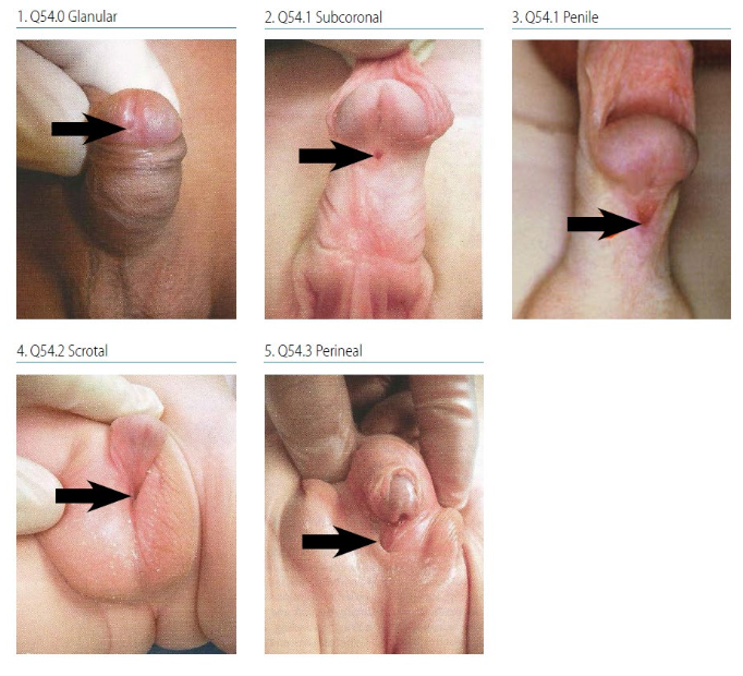 <p>Hypospadias signs and symptoms:</p><ul><li><p>Inability to urinate in ______ position</p></li><li><p class="p1">Ejaculatory dysfunction</p></li><li><p class="p1">Inability to penetrate during coitus</p></li><li><p class="p1">Possible urinary tract obstruction</p></li></ul><p></p>