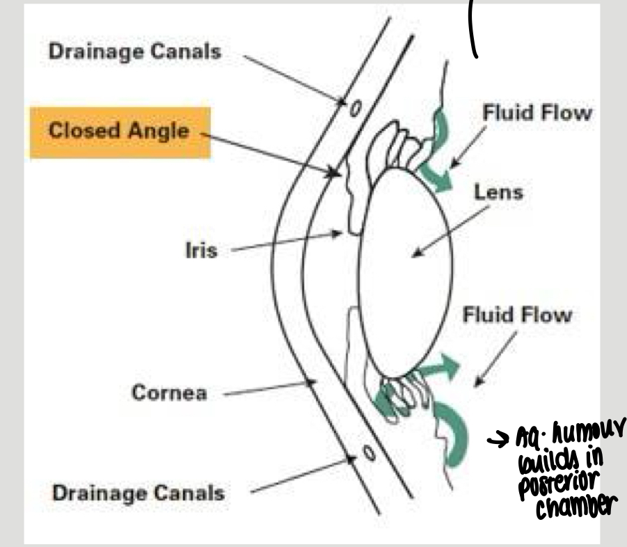 <p>No gap between lens and iris - aqueous humour builds up in the posterior chambers&nbsp;</p>