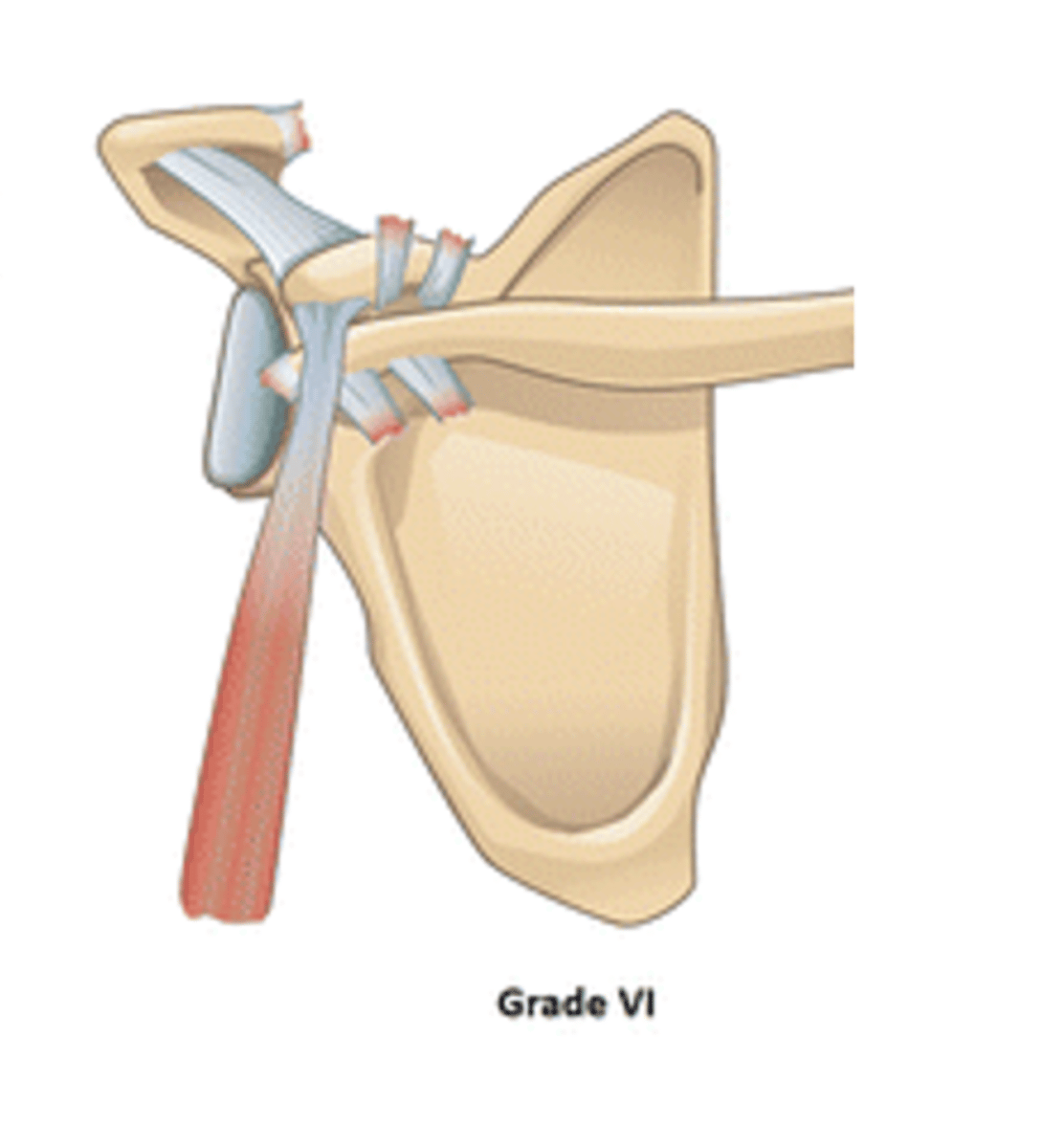 <p>According to the Rockwood Classification System, a grade VI ACJ separation entails: __________</p>