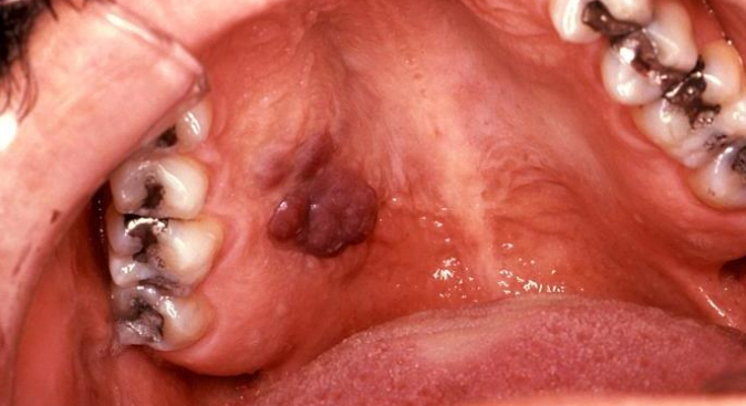 Oral malignancy and Kaposi's sarcoma