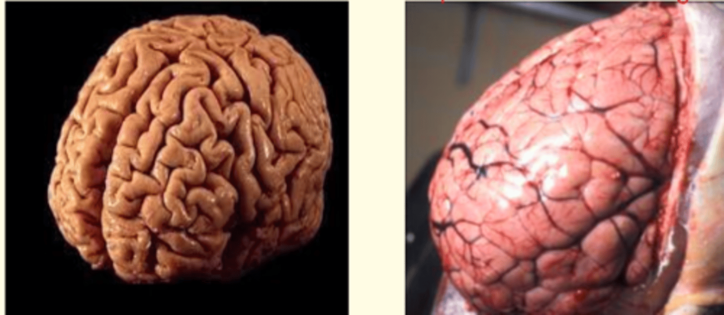 <p>Abnormal accumulation of fluid in the brain (hydropic swelling)</p><p>- Raised ICP</p><p>- Swollen sulci and gyri </p><p>- Cerebral edema </p>