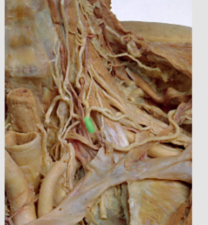 <p>Which artery? (trunk)</p>