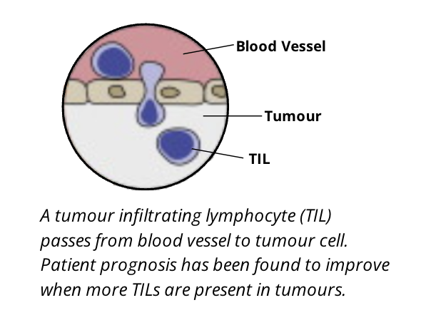 <ul><li><p>although T cells are shown to be the most effective lymphocyte population in killing cancer cells, B cell lymphocytes are also important. these are broadly termed tumour infiltrating lymphocytes</p></li><li><p>the type, density, and location of TILs has been suggested as. a prognostic biomarker in some cancers</p></li><li><p>TILs leave the bloodstream and migrate to infiltrate the tumour under influence of various chemotactic gradients of specific types of chemokines</p></li><li><p>TILs can be a mix of T and B cells. NK cells, dendritic cells, and macrophages also can be of prognostic relevance </p></li><li><p>it is important to note that the number of TILs is not always reflective of their activity and prognostic significance</p></li><li><p>some of the dynamic phenotypic markers expressed on these cells reflect their activation status and therefore must accompany any interpretation on their roles as biomarkers for diagnosis, such as in the case of breast cancer</p></li></ul><p></p><p>Prognostic biomarker: biological characteristics that are objectively measured and evaluated to predict the course of a disease or response to a therapeutic intervention among patients with the same characteristic</p><p>Biomarkers: a measurable substance in an organism, the presence of which is indicative of some phenomenon such as disease, infection, or environmental exposure</p><p></p>