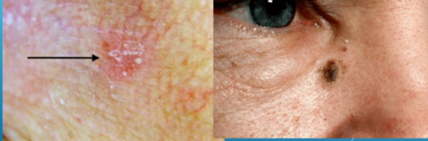 <p>topical 5-FU = preferentially taken up by rapidly dividing cells, then inhibits DNA synthesis and RNA transcription</p><p>imiquimod cream = immune modulator = toll-like 7 receptor antagonist</p><p>diclofenac gel = NSAID blocks COX pathway = apoptosis and anti-angiogenesis</p><p>PDT blue light therapy on 5-ALA cream</p><p>excision</p><p>cryosurgery with liquid nitrogen</p>