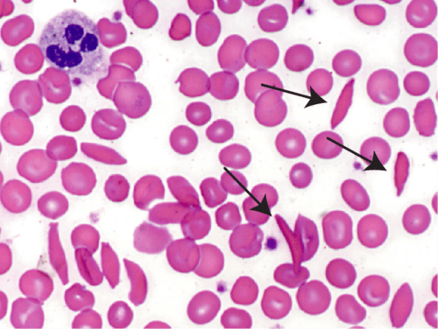 <p>crescent-shaped erythrocytes AKA RBCs saw in a type of anemia, causes pain, RBC destruction and blocks blood flow to tissues</p>