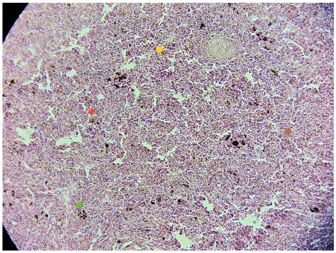 <p><strong><em>Plasmodium sp.</em></strong></p><p>(śledziona - malaria melanemia)</p><p></p><p></p><p><strong>Cechy charakterystyczne</strong>:</p><p></p><ul><li><p><span data-name="red_circle" data-type="emoji">🔴</span><span data-name="yellow_circle" data-type="emoji">🟡</span><span data-name="green_circle" data-type="emoji">🟢</span><span>️</span><span data-name="brown_circle" data-type="emoji">🟤</span><span> - złogi hemosyderyny.</span></p></li></ul><p></p><p></p><p><strong>Parazytoza</strong>: <em>Malaria</em></p>