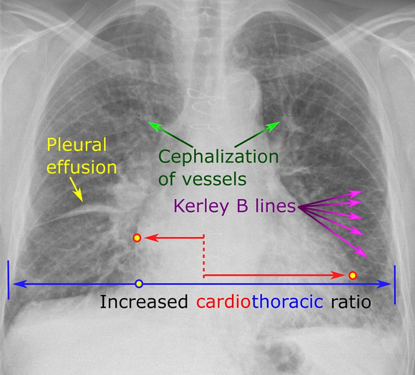 <ul><li><p><span style="background-color: transparent;"><span>(CHF) Congestive heart failure&nbsp;typically presents with&nbsp;one of two radiographic patterns:&nbsp;</span></span></p><ul><li><p><span style="background-color: transparent;"><span>pulmonary interstitial edema&nbsp;</span></span></p></li><li><p><span style="background-color: transparent;"><span>pulmonary alveolar edema</span></span></p></li></ul></li></ul><p></p>