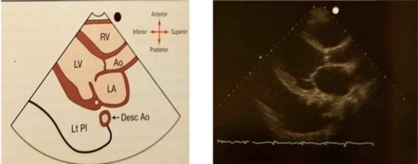 <p>A buildup of fluid between the tissues that line the lungs and the chest.</p>