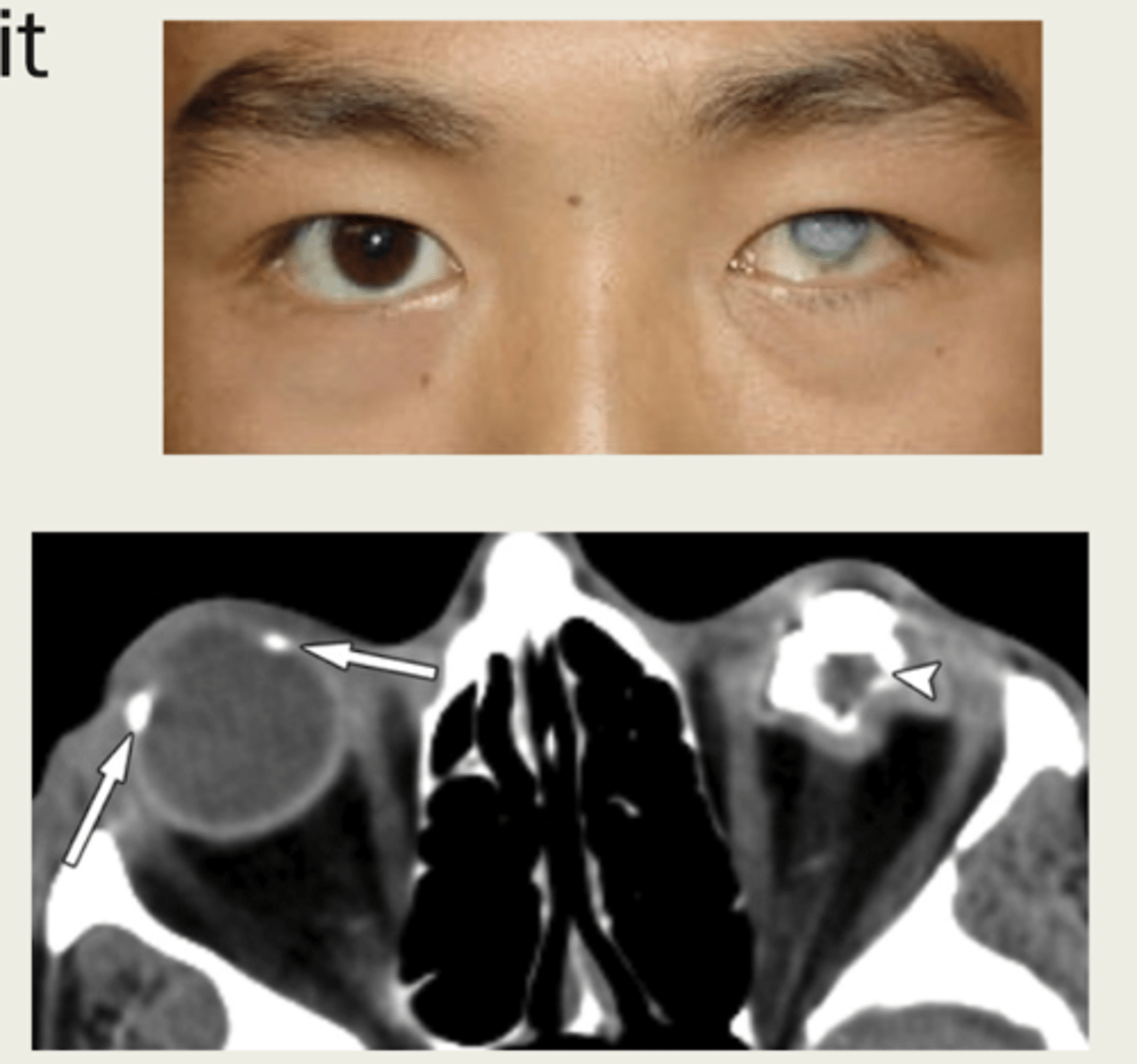 <p>1. trauma</p><p>2. infection</p><p>3. malignancy</p><p>4. retinal detachment</p><p>5. vascular lesion</p>