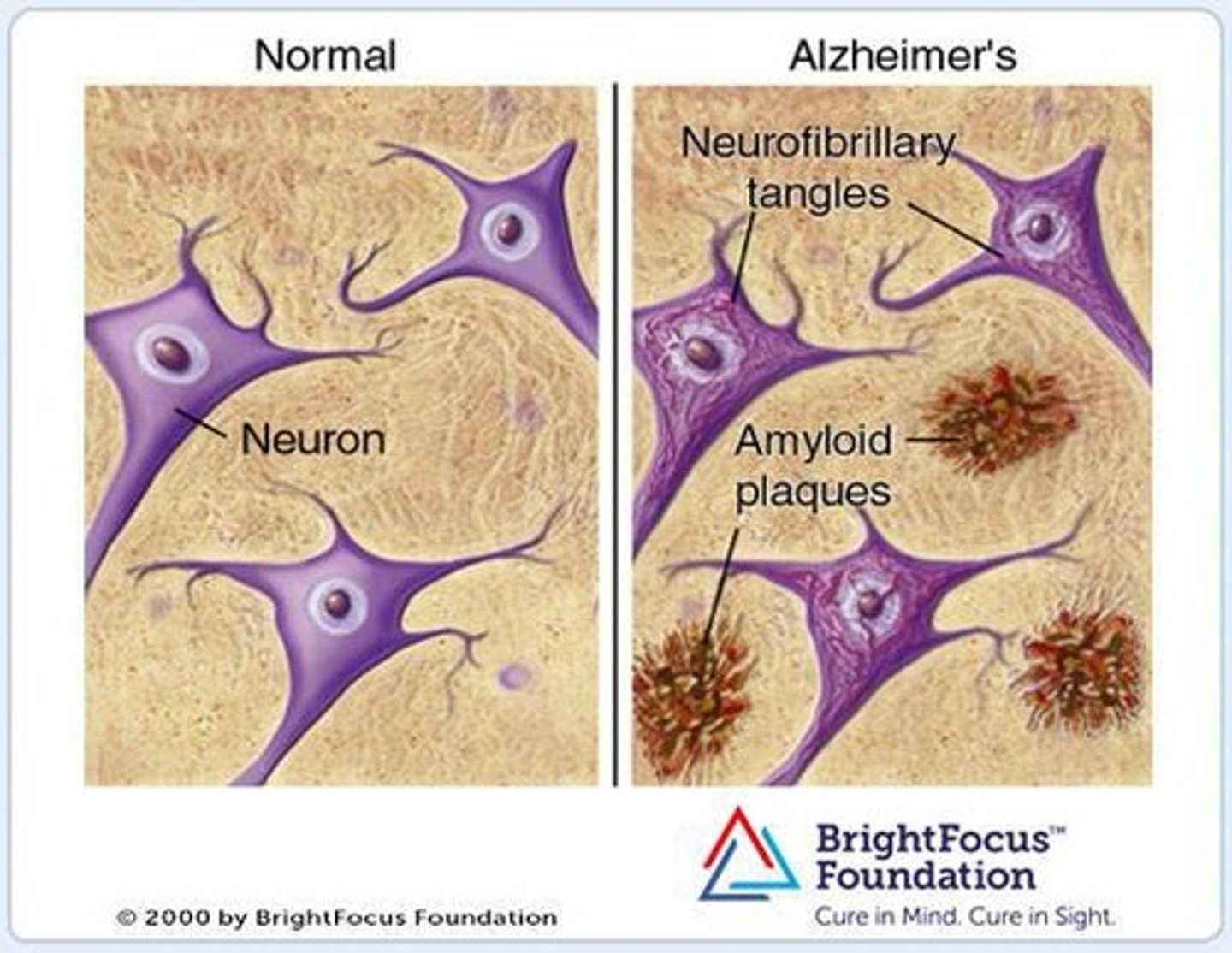 <p>A protein found in excessive amounts in the brains of Alzheimer's patients, associated with plaque formation.</p>