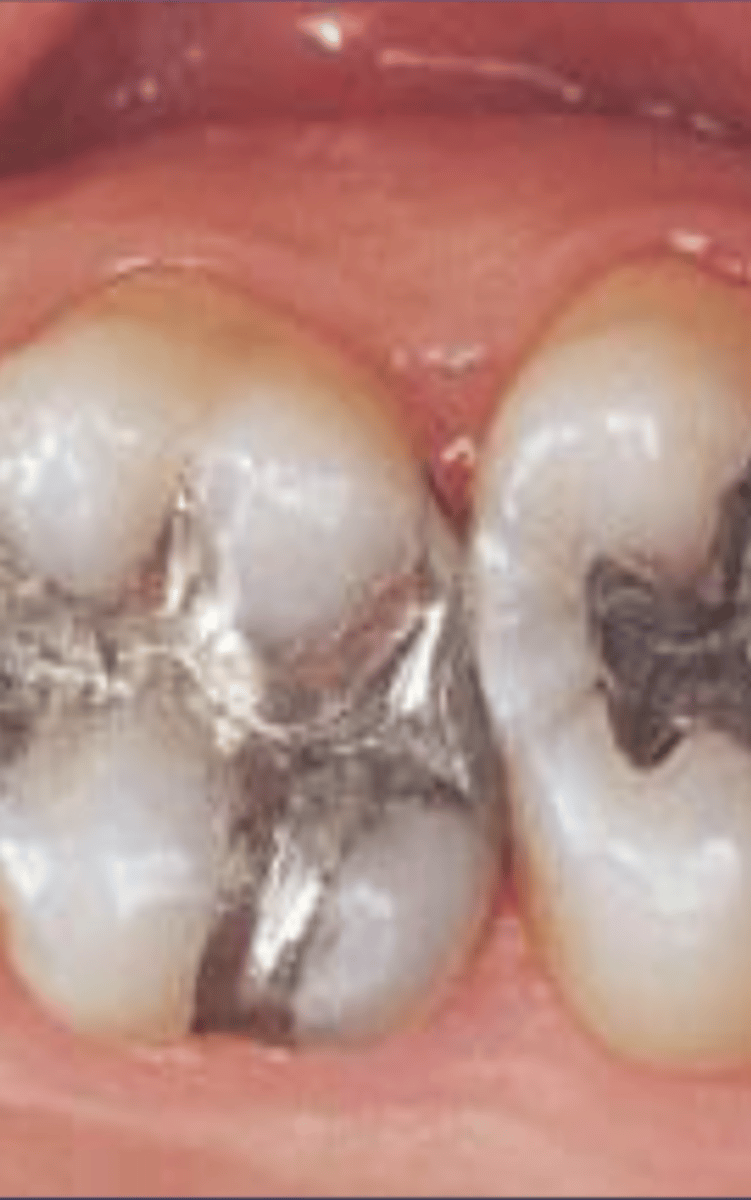 <p>Completely opaque</p><p>- One surface amalgam - B,L,O, I</p><p>- Multisurface - MO, MOD, ML, OL</p><p>- Overhangs</p><p>- Amalgam fragments</p>