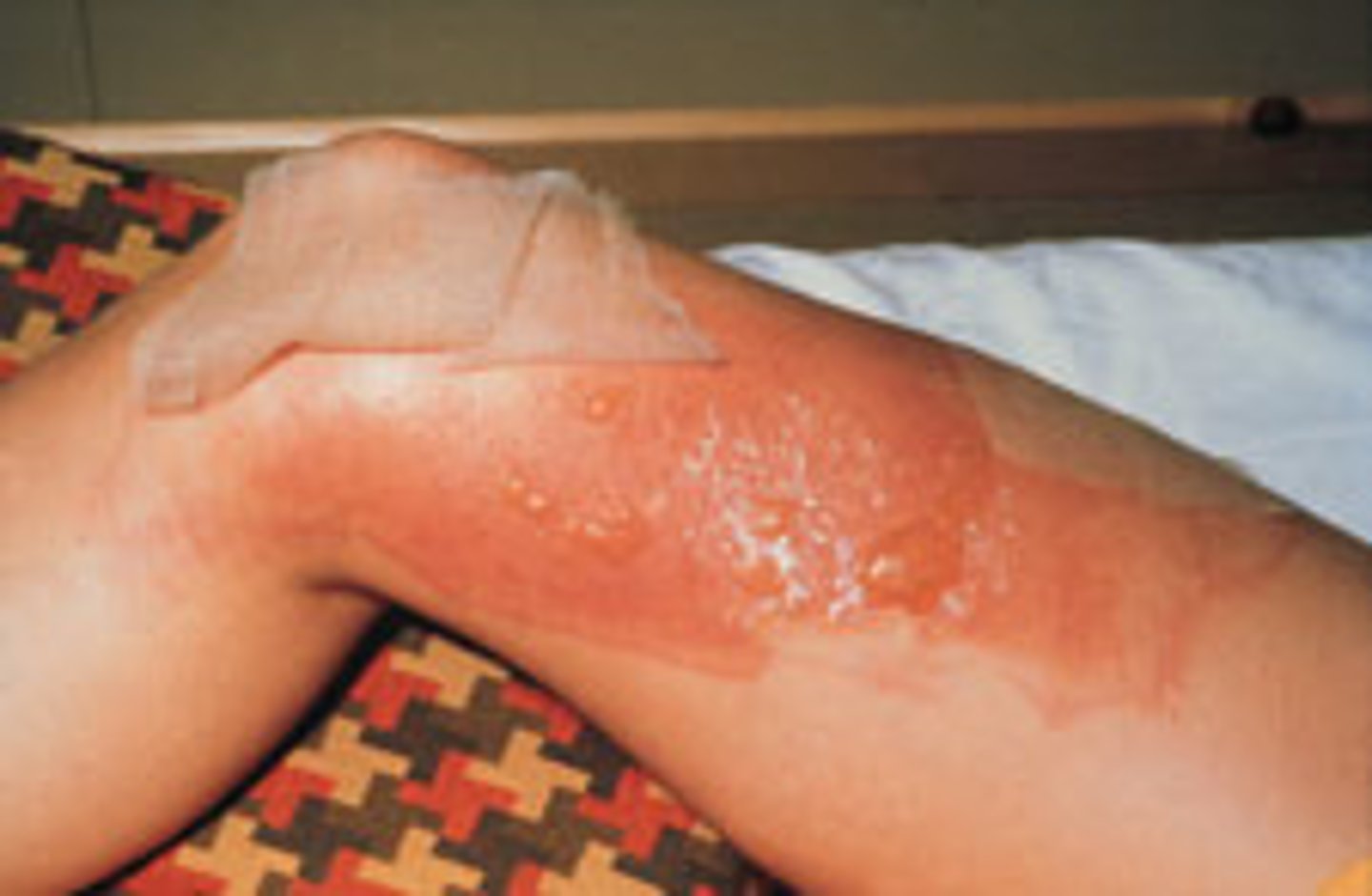 <p>A burn marked by pain, blistering, and superficial destruction of dermis with edema and hyperemia of the tissues beneath the burn.</p>