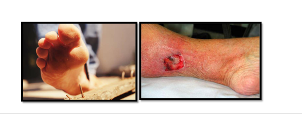 <ul><li><p><span><span>при навлизане в организма тетаничният бактерии се размножава</span></span><br><span><span>само в травматизираната тъкан, няма инвазивни свойства. След</span></span><br><span><span>освобождаване на екзотоксина от вегетативната клетка той се пренася</span></span><br><span><span>до главния и гръбначния мозък по кръвен и нервен път. Предизвиква се</span></span><br><span><span>хиперактивация на моторните неврони и на симпатиковата нервна</span></span><br><span><span>система</span></span></p></li></ul><p></p>