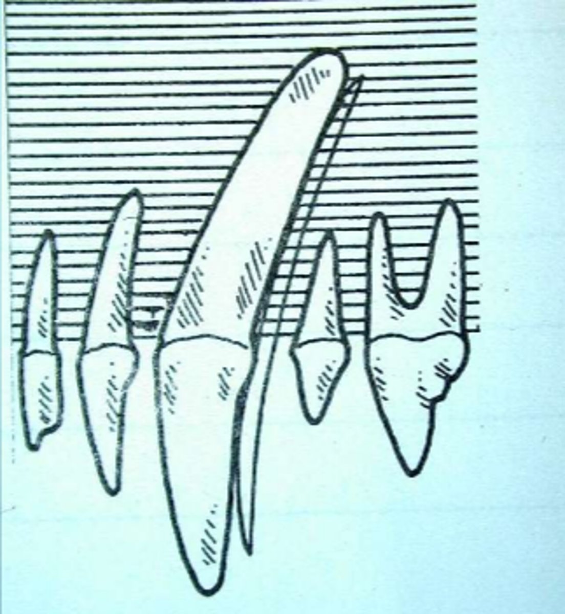 <p>When you see this on a dental record, what does it mean?</p>