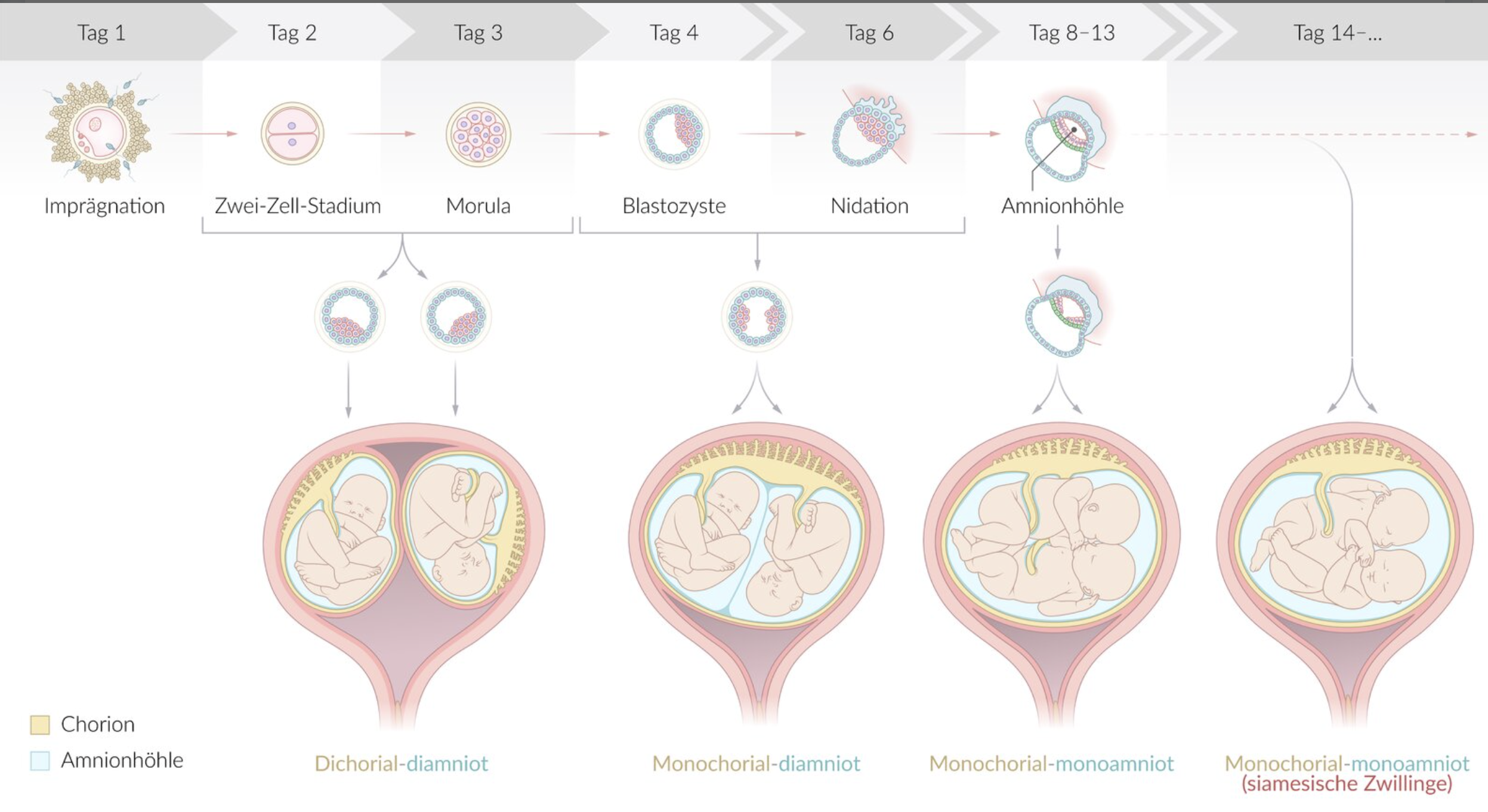 <p>A. Shared amniotic sac (amnion), shared placenta</p>
