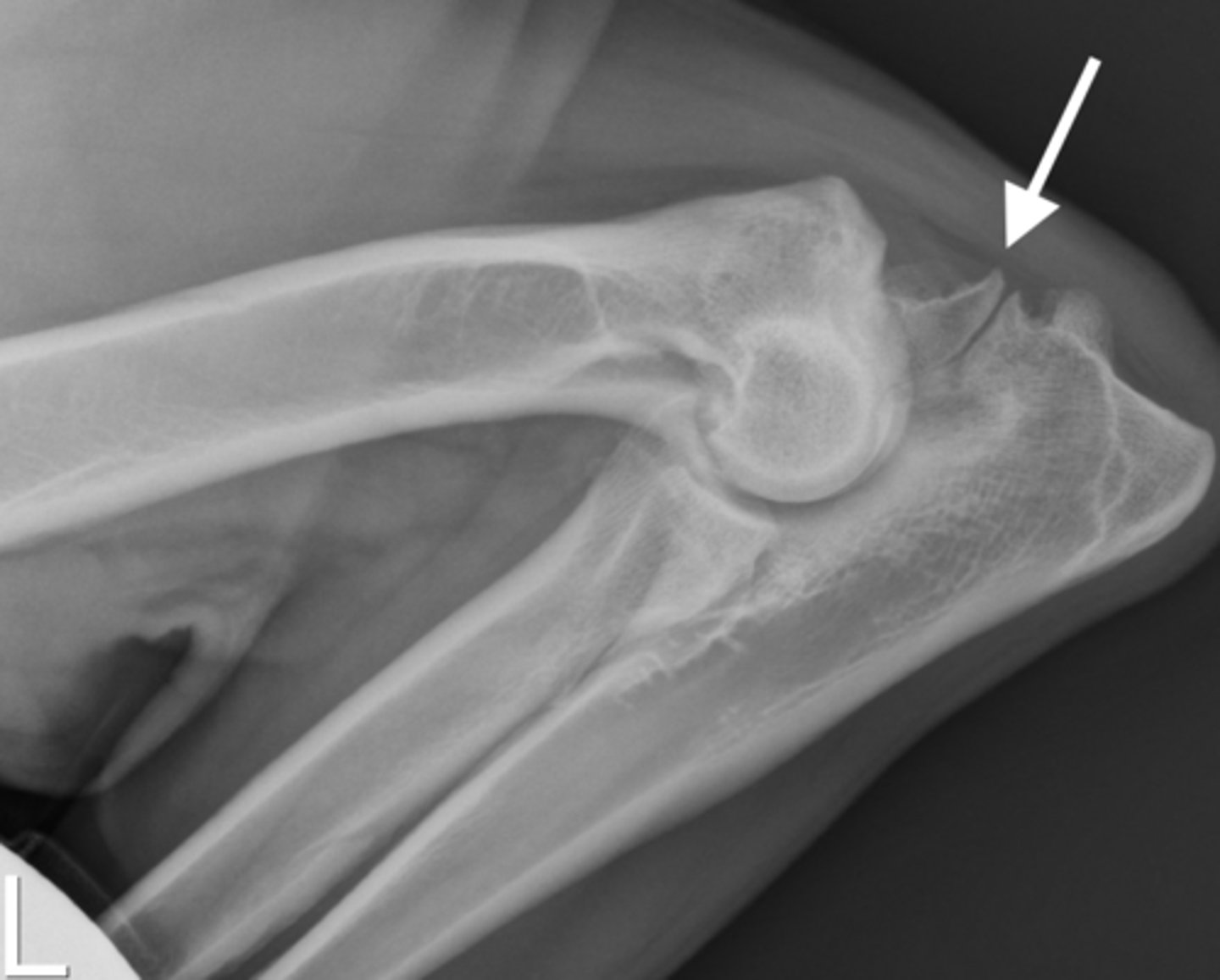 <p>Name a few articular calcified bodies?</p>