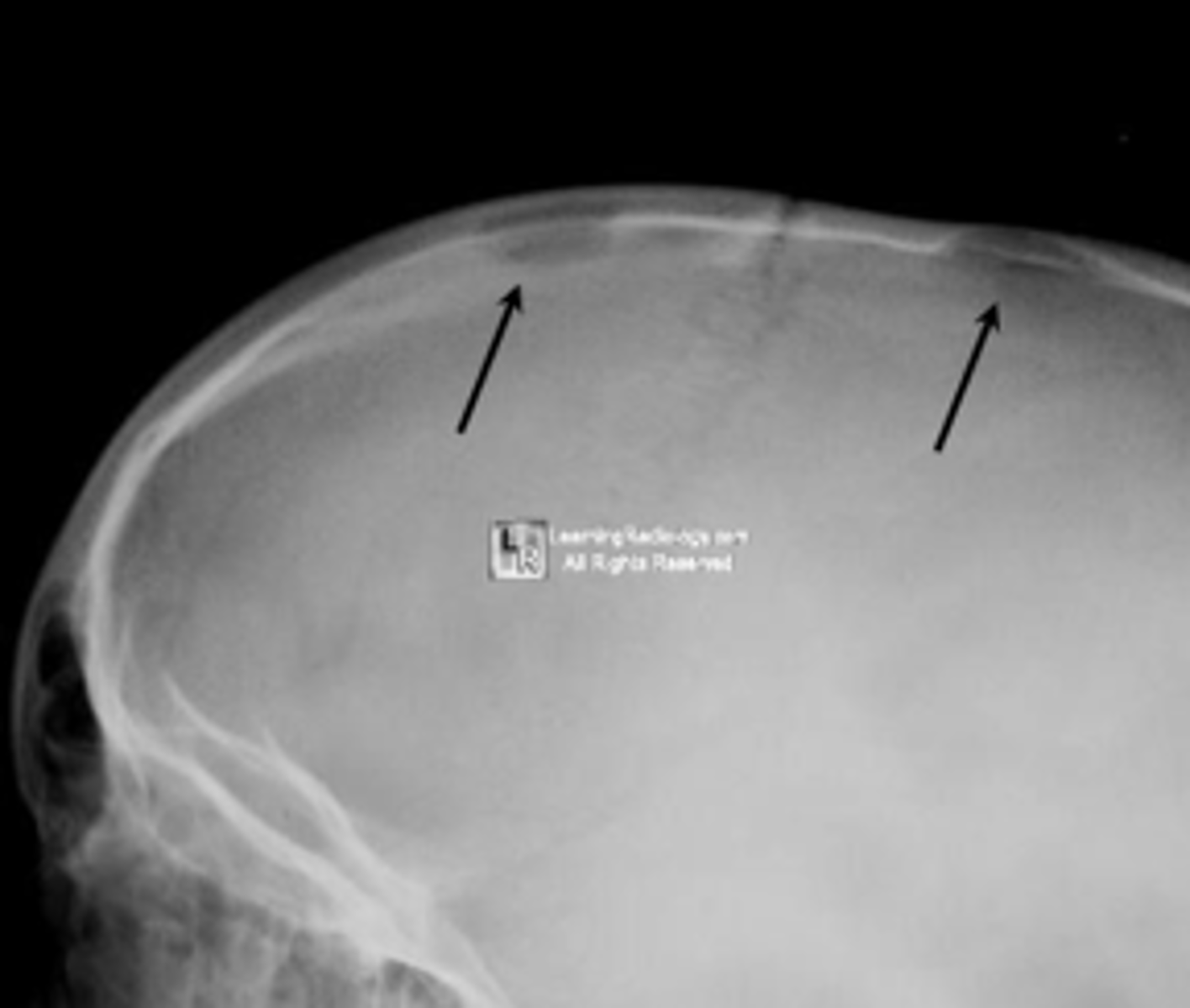 <p>ID radiographic feature of eosinophilic granuloma in the skull</p>