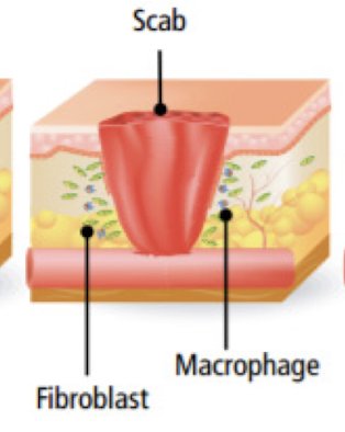 <p>Which <strong>second phase</strong> of wound healing are <strong>bacteria and debris phagocytized and removed and factors released that cause the migration and division of cells of proliferative phase</strong>?</p>
