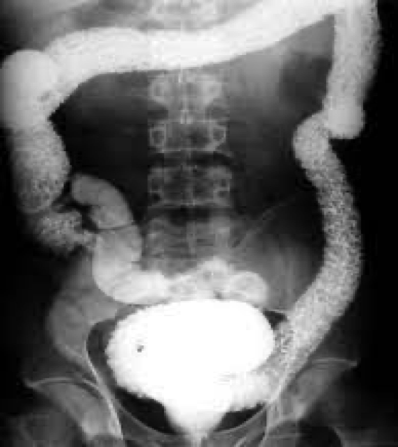 <p>IBD</p><p>Young adults</p><p>Symptoms come and go</p><p>Extreme dilation of colon</p><p>Involves mucosal layer</p>