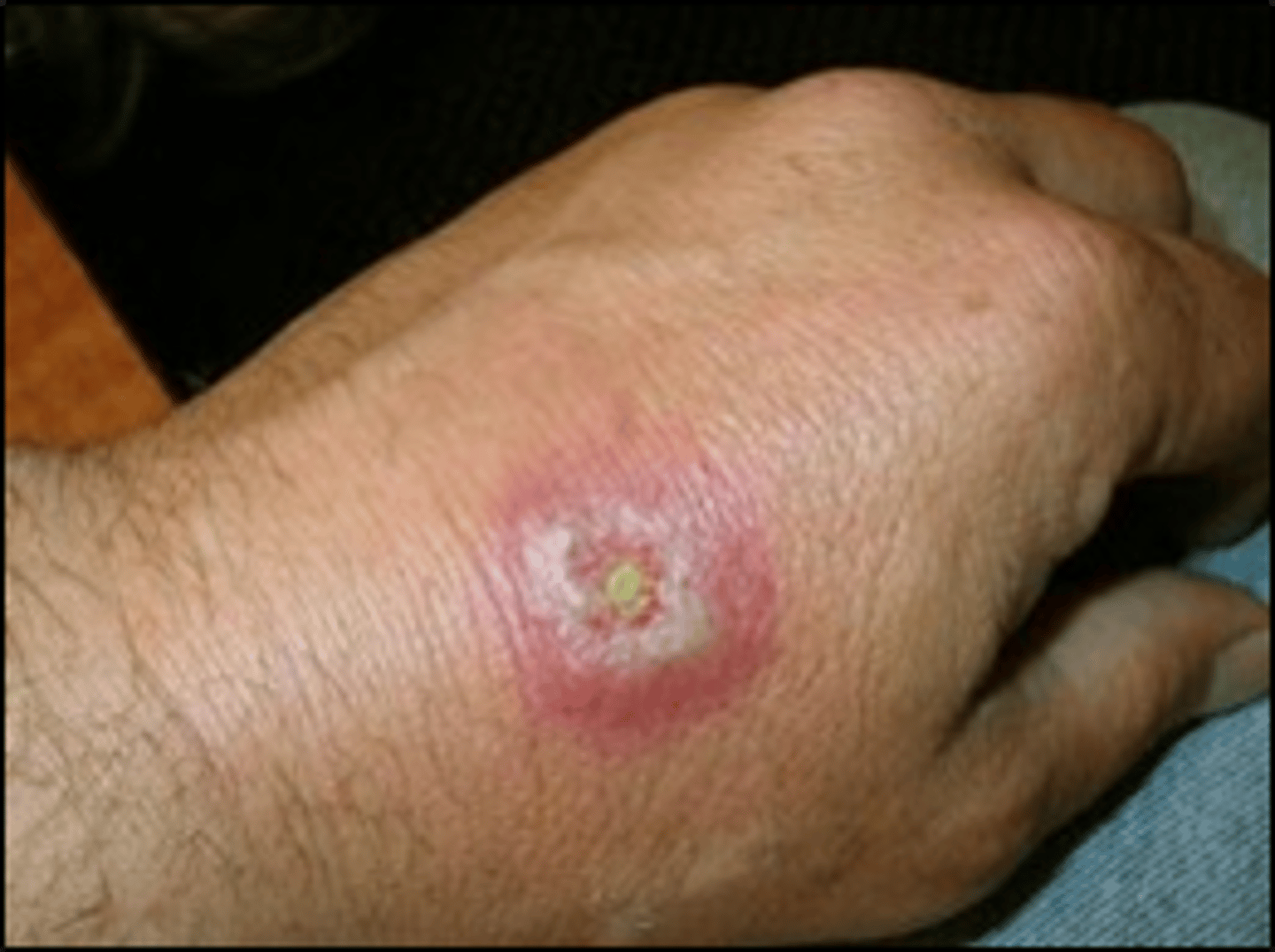 <p>diagnose this:</p><p>Can cause a significant reaction: infarct of skin</p>