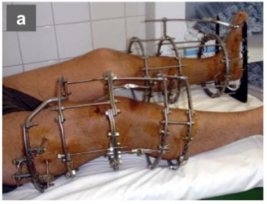 <p>external fixators</p>