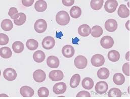 <p>Identify these types of red cells.</p>