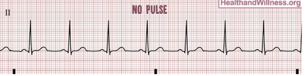 <p>PULSELESS ELECTRICAL ACTIVITY (PEA) nursing actions</p>