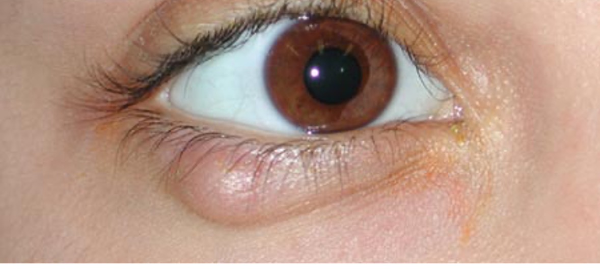 <p>chronic enlargement of meibomian gland due to obstruction</p>