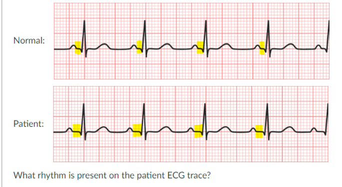 <p>JONES IN CLASS ASSIGNMENT QUESTIONS:</p><p>a. sinus rhythm</p><p>b. second degree heart block</p><p>c. STEMI</p><p>d. first degree heart block</p>