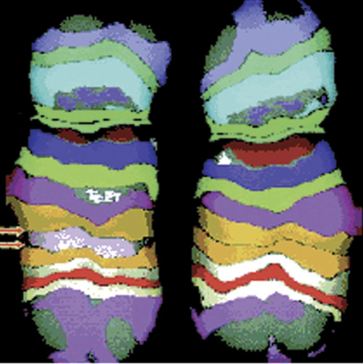 <p>gene segment between arrows deleted and the flanking ends rejoined</p><p>- cancer ex. loss of inhibitory gene</p>