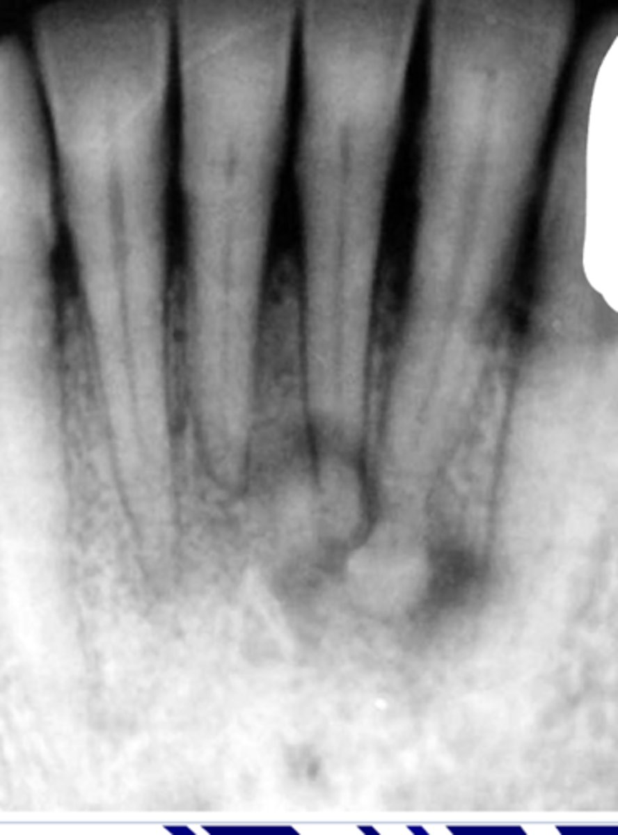 <p>Mixed RL/RP lesions</p><p>- Do nothing, cleanings</p>