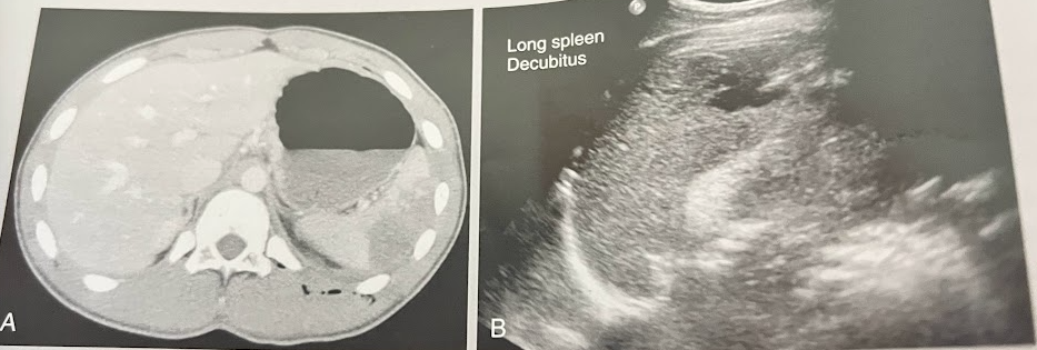 <p>A 16 year old pt presents to the ED w/a gunshot wound to the LUQ. A focused assessment by sonography for trauma (FAST) sonogram performed in the ED did not reveal peritoneal fluid or bleeding. A complete blood count indicated normal values w/the exception of a decreased hematocrit. The BP was stable. The pt was referred for a CT, which demonstrated a subcapsular splenic abnormality; the remainder of the study was normal. The sonogram identified the findings in the image as the absence of free peritoneal fluid. Discuss these findings.</p>