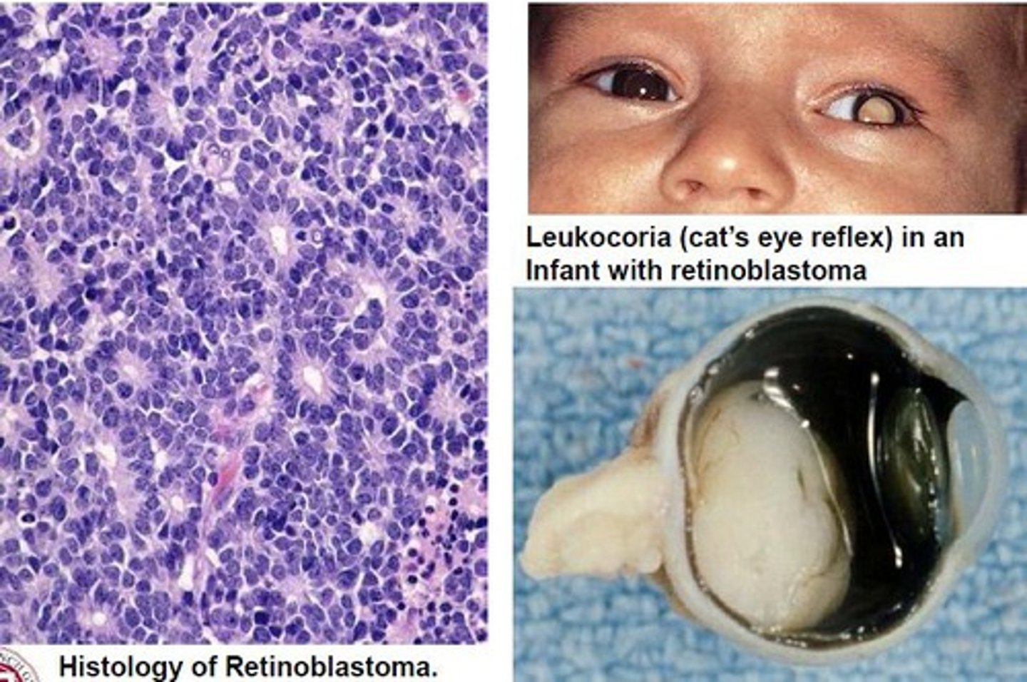 <p>Information for Condition:</p><p>-Hereditary &amp; sporadic forms of cancer (40%) = mutation of RB tumor suppressor gene (normally brake on cell cycle &amp; responsible for primitive neuronal differentiation)</p><p>-Tumor = Lobulated retinal tumor</p><p>-See small blue cells, rosettes, necrosis &amp; calcifications</p>