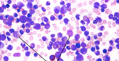 <ul><li><p><span>Cancer when the white blood cells are high and red blood cells and platelets are low</span></p></li></ul>