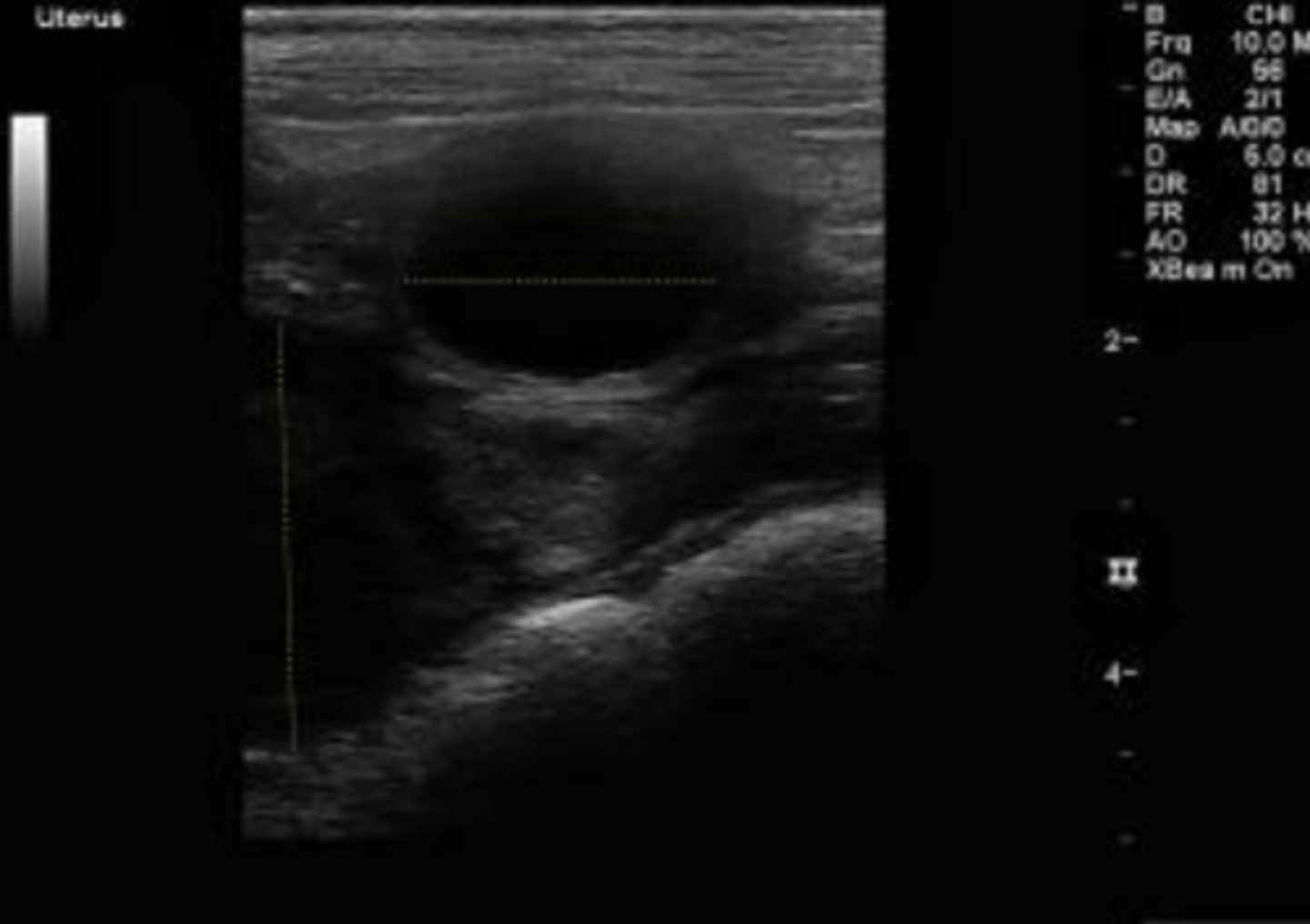 <p>What are the hallmark sonographic findings for pyometra, mucometra, and hydrometra?</p>