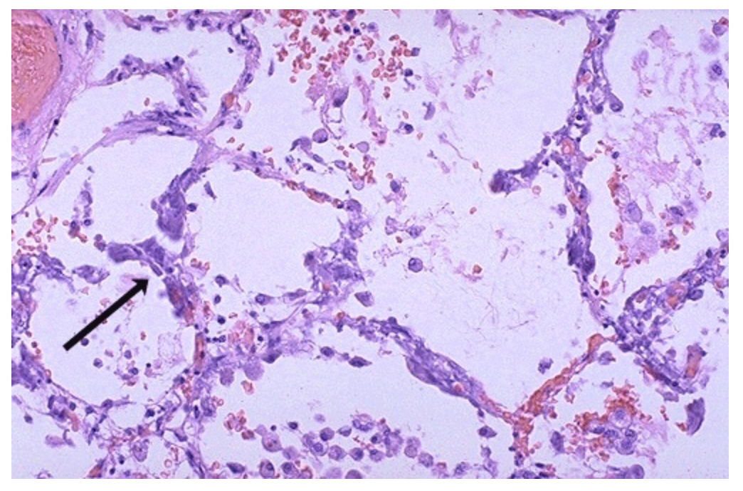<p>This is a lung of a patient with high serum calcium level (hypercalcemia). What type of calcification is this?</p>